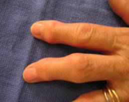 Arthrose du doigt : déformation latérale et dorsale de l'articulation
